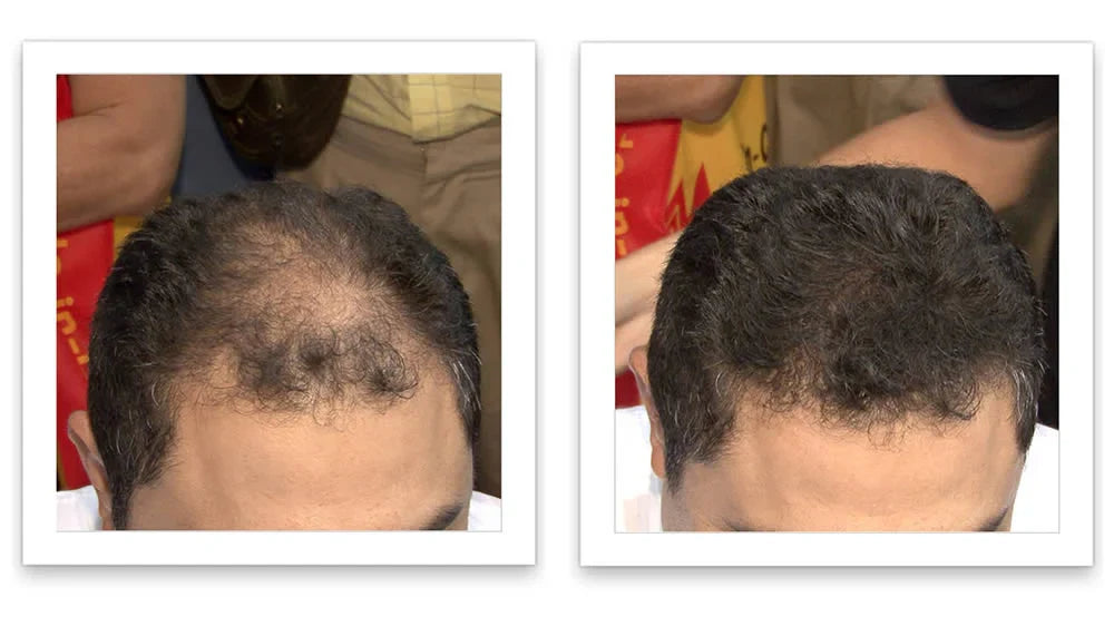 Antes y despues del uso de Caboki 30 gr — foto de resultado del propio cliente