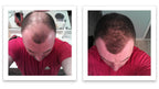 Antes y despues del uso de Caboki 30 gr — foto de resultado del propio cliente