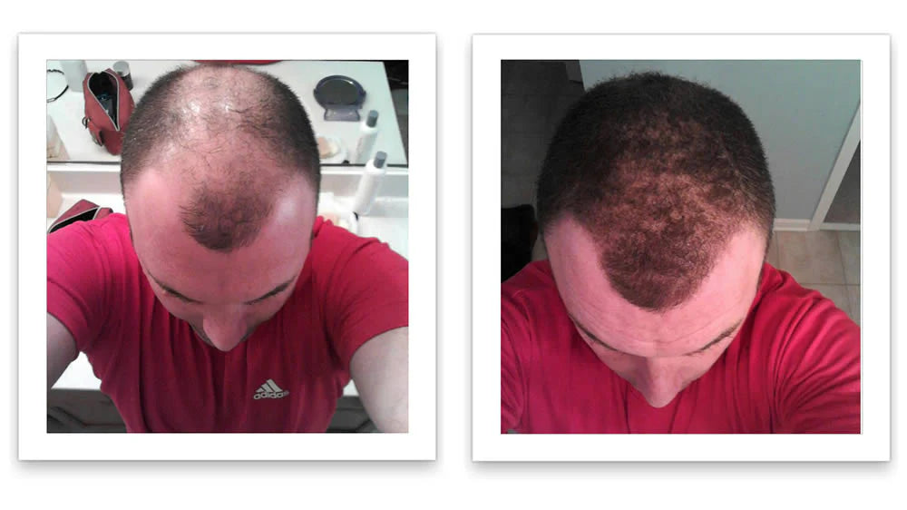 Antes y despues del uso de Caboki 30 gr — foto de resultado del propio cliente