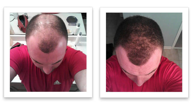 Antes y después del uso de Caboki 30 g — foto de resultado del propio cliente