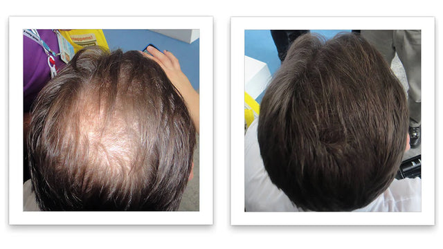 Antes y después del uso de Caboki 30 g — foto de resultado del propio cliente
