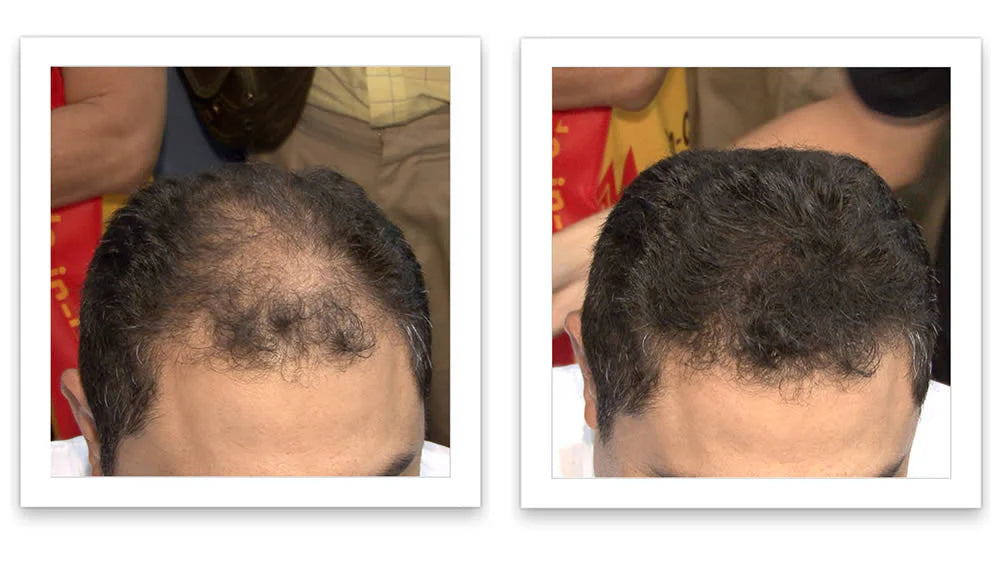 Antes y despues del uso de Caboki 30 gr — foto de resultado del propio cliente