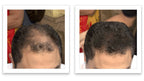 Antes y despues del uso de Caboki 30 gr — foto de resultado del propio cliente