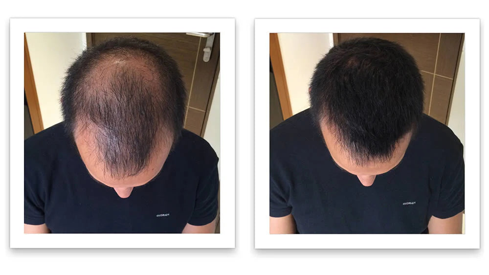 Antes y despues del uso de Caboki 30 g — foto de resultado del propio cliente