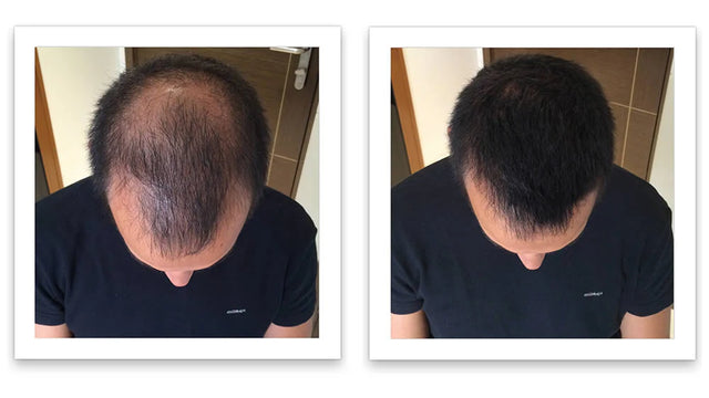Antes y después del uso de Caboki 30 g — foto de resultado del propio cliente