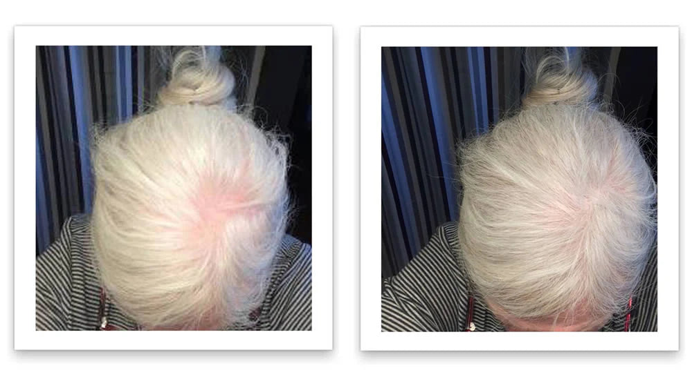 Antes y despues del uso de Caboki 30 g — foto de resultado del propio cliente