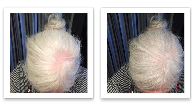 Antes y después del uso de Caboki 30 g — foto de resultado del propio cliente