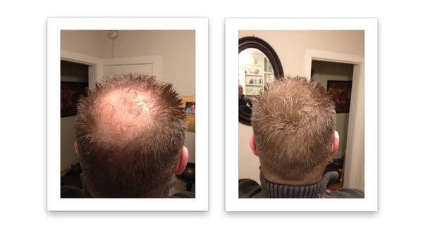 Antes y despues del uso de Caboki 30 g — foto de resultado del propio cliente