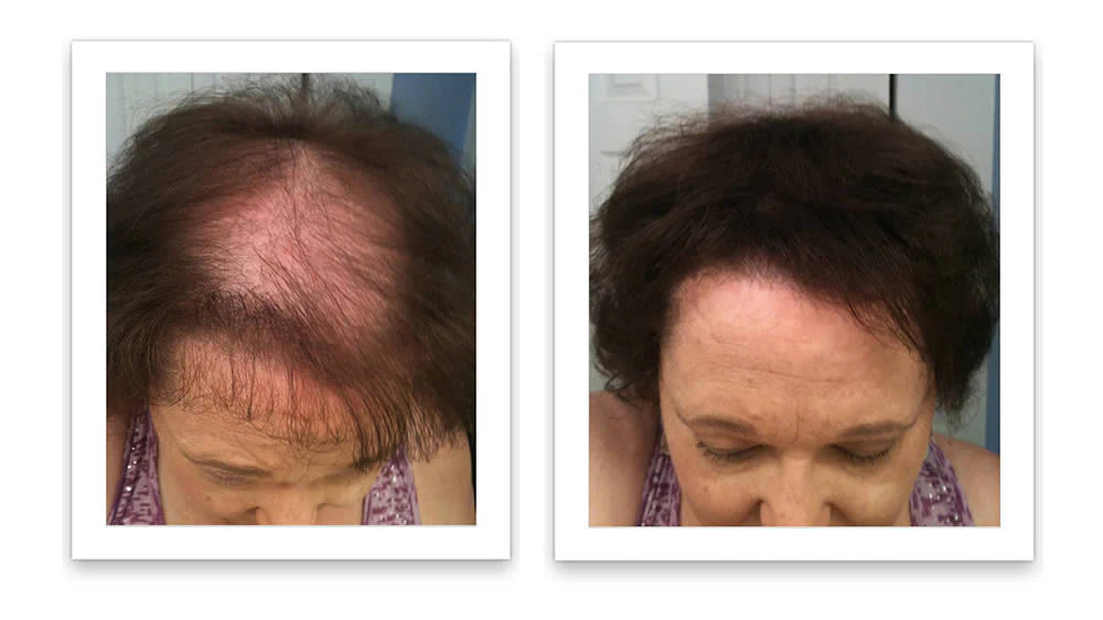 Antes y despues del uso de Caboki 30 g — foto de resultado del propio cliente