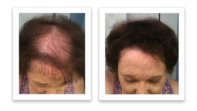 Antes y después del uso de Caboki 30 g — foto de resultado del propio cliente
