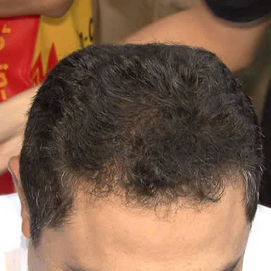 Antes